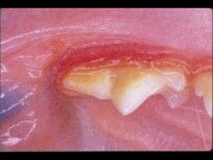 Inflammation of the gum tissue surrounding the molar teeth. Daily tooth brushing will help prevent dental disease.