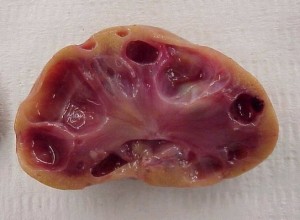 Cut section of a kidney showing the cysts within.