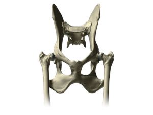 Illustration of dysplastic hips. Notice how the ball of the leg bone does not rest within the hip socket.