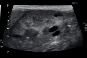 Ultrasound image of cysts within the kidneys (black oval lesions).