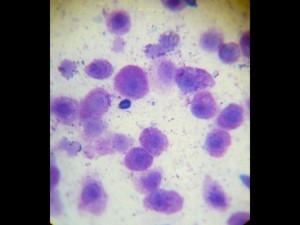 Microscopic view of a mast cell tumor. Mast cells contain numerous pink staining granules.