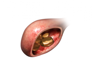 Stones can form in the urinary bladder resulting in irritation and potentially obstruction.
