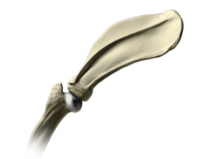 Osteochondritis dissecans of the shoulder joint. Note the loss of cartilage on the ball portion of the joint.