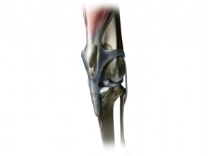 Illustration of patellar luxation. Notice how the knee cap has moved out of the groove it normally resides in.