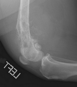 Bone weakened by osteosarcoma (bone cancer) has caused a fracture.