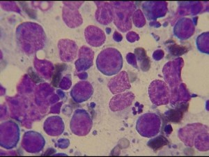 Abnormal lymphocytes, as seen under the microscope, confirming a diagnosis of lymphoma.