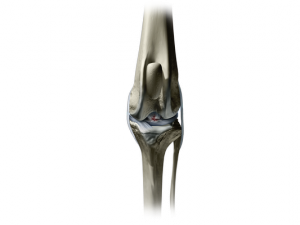 Illustration showing a tear in the cranial cruciate ligament of the knee joint.